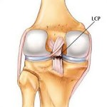 ligamento cruzado posterior de la rodilla