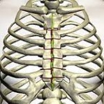 prótesis en 3D: Cirugía torácica